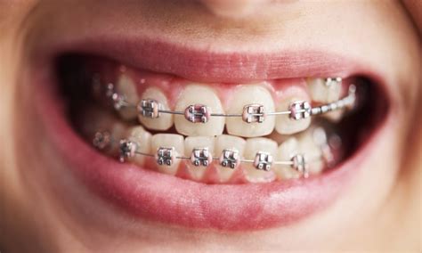 Swollen Gums With Braces Liberty Village Dental Care