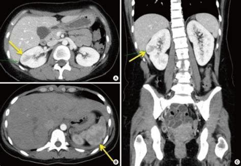 Abdominal Pelvic Ct Scan Showed Focal Wedge Shaped Low Open I