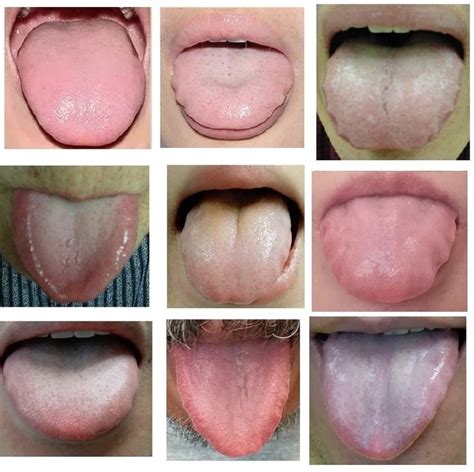 Check Your Tongue Signs Every Morning They Reflect Actual Yet First
