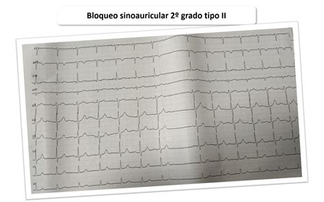 Bloqueo Sinoauricular 2º Grado Tipo Ii Cardioprimaria Ferrol