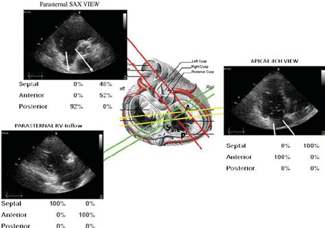 Visualization Of The Tricuspid Valve Leaflets By Two Dimensional