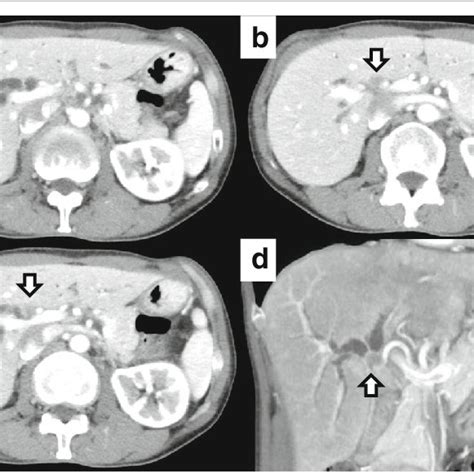 Contrast Enhanced Abdominal Computed Tomography Ct Findings