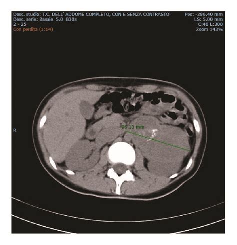 Abdominal Ct Scan With And Without Contrast Enhancement Presence Of A