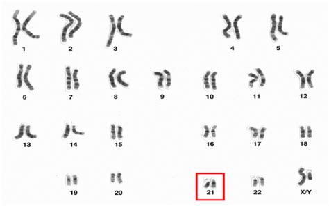 Novel Insight Into Chromosome 21 And Its Effect On Down Syndrome Ucl News Ucl University