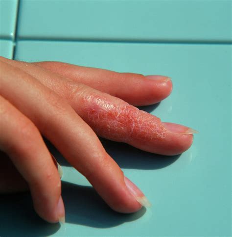 Eczema Affecting A Womanss Finger Photograph By Sheila Terryscience