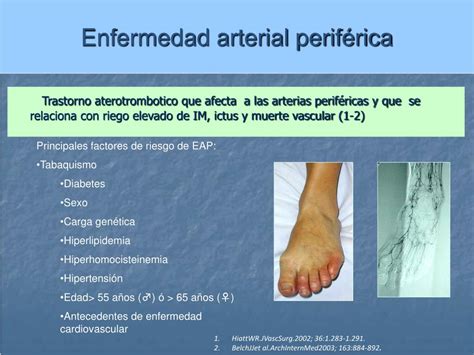 Ppt Indice Tobillo Brazo Y Enfermedad Arterial Periférica Powerpoint