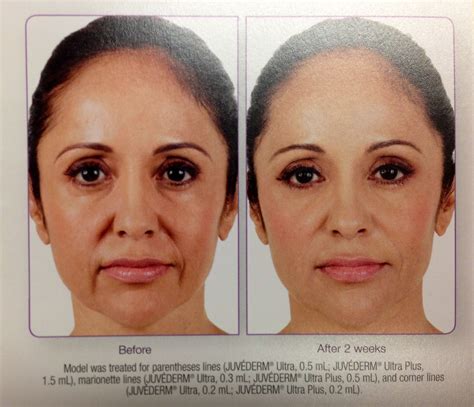 Juvederm A Filler Used Here For The Paranthesies Around The Mouth And