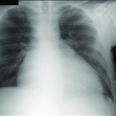 Chest X Ray Posteroanterior Marked Cardiomegaly Rectified Middle