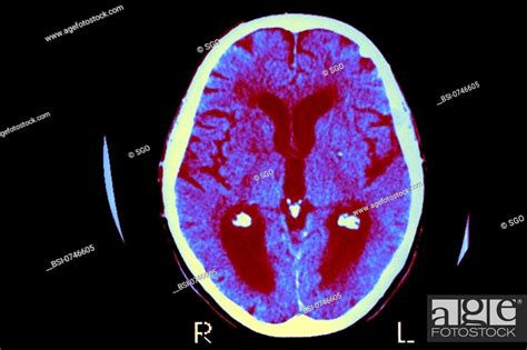 Alzheimers Disease Scan Axial Cut Away View Median Portion Of
