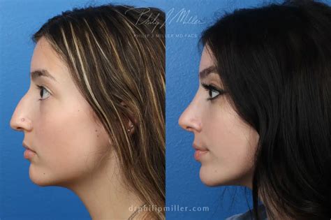 Rhinoplasty Swelling Stages What To Expect Philip Miller Md