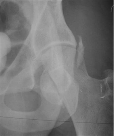Femoral Head Fractures Trauma Orthobullets