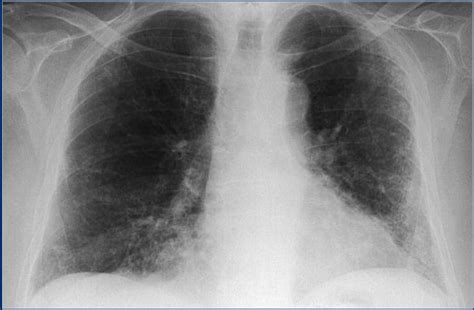 The Radiology Assistant Chest X Ray Lung Disease