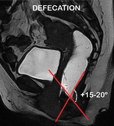 Mr Imaging Based Assessment Of The Female Pelvic Floor Radiographics