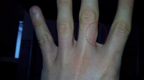 Protrusion On My Finger Orthopaedic Disorders Forums Patient