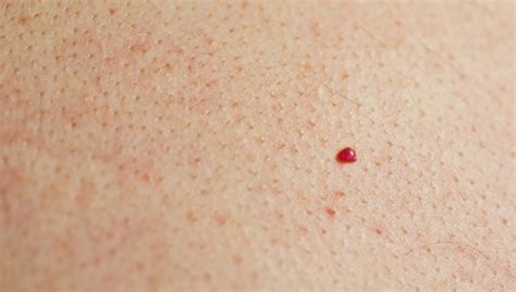 Cherry Angioma Identification Causes And Treatments