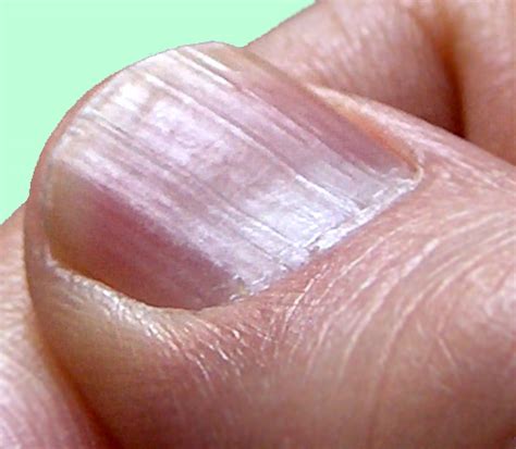 They provide immunity and promote the growth of hair and nails. What causes split nails and ridges - Awesome Nail