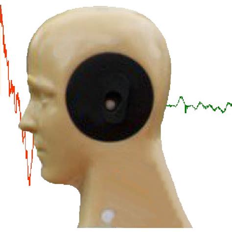 Endoscopic View Of The Right Ear Showing Wax Impaction Against The