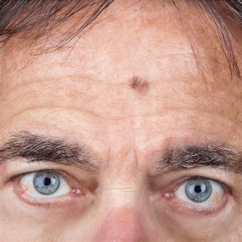 Brown Spot Skin Cancer On Face