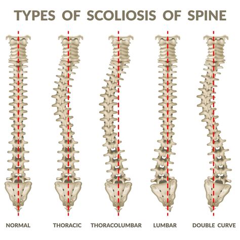 Comprehensive Guide To Understanding Scoliosis In Houston Tx