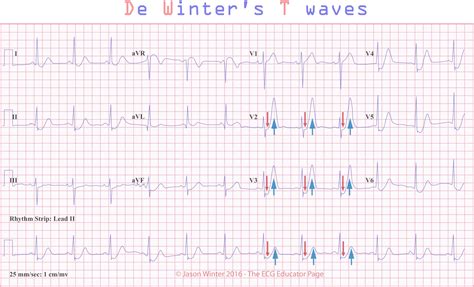 Middle aged patient presenting with chest. ECG Educator Blog : De Winters T waves