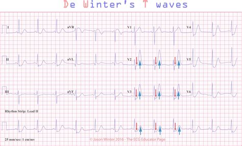 Tutorial site on clinical electrocardiography (ecg). ECG Educator Blog : De Winters T waves