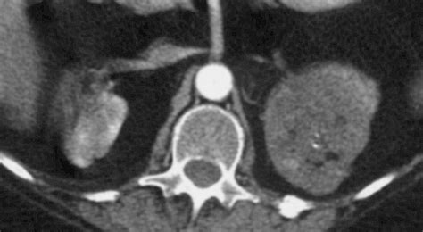 Ct And Mr Imaging Of The Adrenal Glands In Acth Independent Cushing