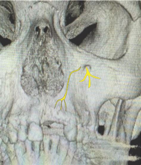 Structure Of Anterior Superior Alveolar Nerve Semantic Scholar