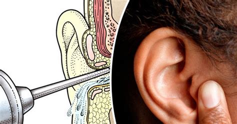 Watch Disgusting Footage Of Wax Filled Ear Being Unblocked Daily Star