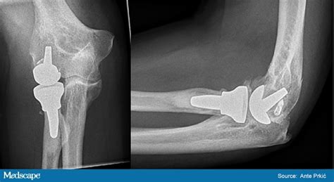 Total Elbow Replacement What You Need To Know Toca The Orthopedic