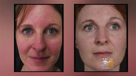 Health Watch New Laser Treatment For Rosacea Youtube