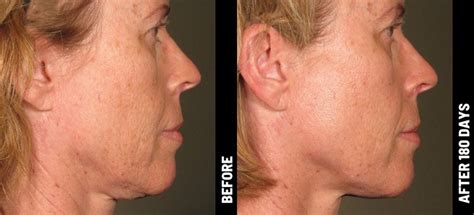 Ultherapy Non Surgical Facelift Greenville Sc Alma Rose