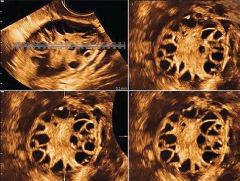 Tomographic Ultrasound Image Tui In A Transversal Plane Of A