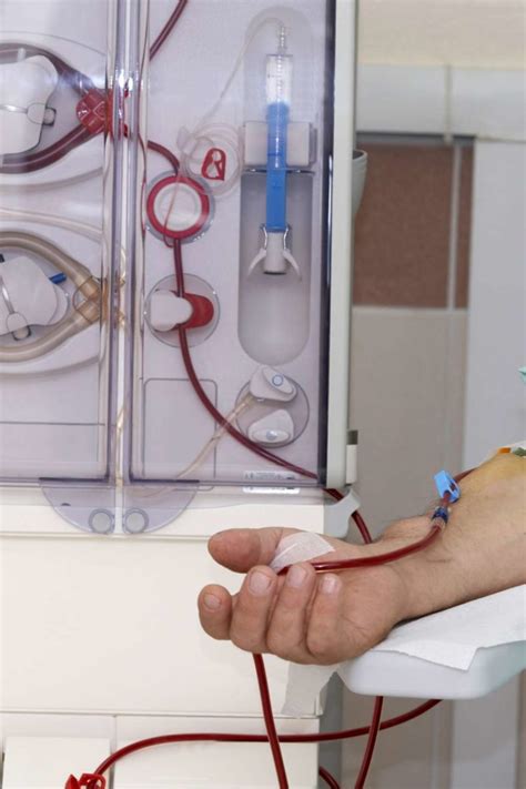 Dialysis Procedure Purpose Types Side Effects And More