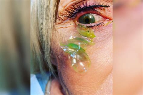Video Shows Doctor Removing 23 Contacts From Womans Eye