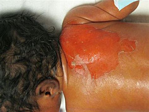 Staphylococcal Scalded Skin Syndrome In A Preterm Newborn