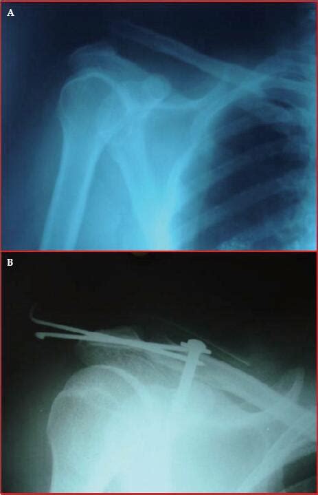 Combined Intra Articular K Wire And Coracoclavicular Screw Fixation For