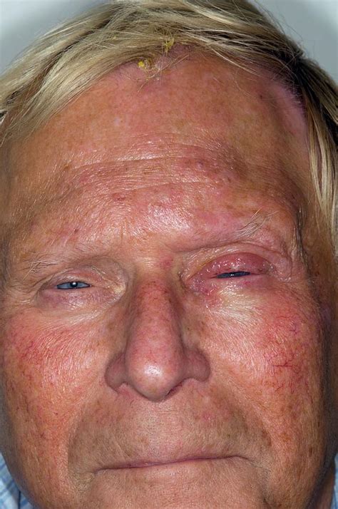 Shingles Rash On The Forehead Photograph By Dr P Marazzi Science Photo