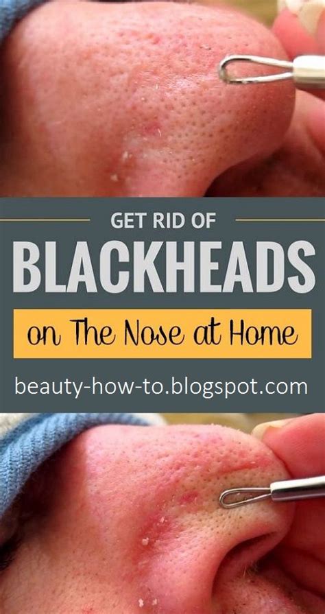 How To Get Rid Of Blackheads On The Nose Brown Spots On Face Spots