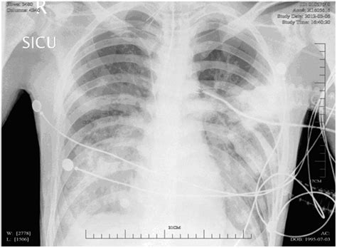 Chest Radiograph On Admission Showing Bilateral Dense Infiltrates