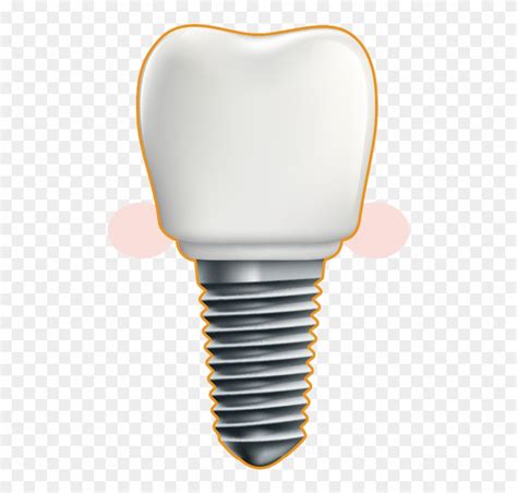 Dental Implant Illustration Clipart 1853806 Pinclipart