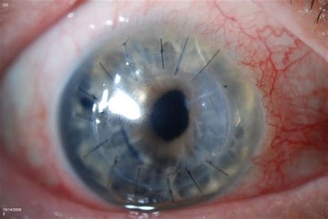 Cornea Transplant Rupture 1 Retina Image Bank