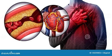 Myocardial Infarction Human Heart Disease Stock Illustration