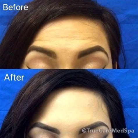 Eyebrow Lift Using Botox Eyelid Surgery Cost Photos Rewiews Qanda