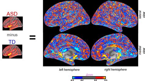 Autism Brain Origins Environment And Physiology Really Matter Autism