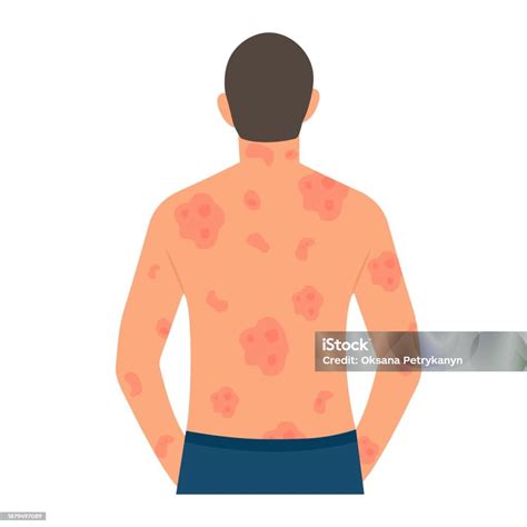 Dermatological Skin Disease Psoriasis Stock Illustration Download