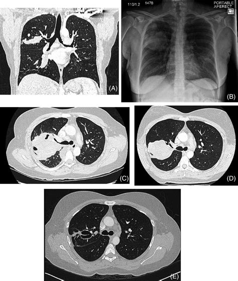 Pulmonary Actinomycosis And Polymicrobial Empyema In A Patient With