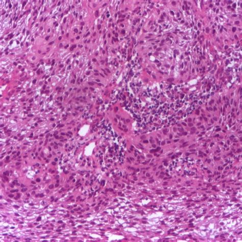 Large Cell Non Keratinizing Squamous Carcinoma Of The Cervix He