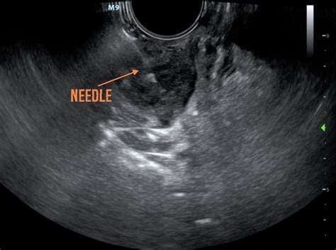 Hennepin Ultrasound Peritonsillar Abscess Drainage