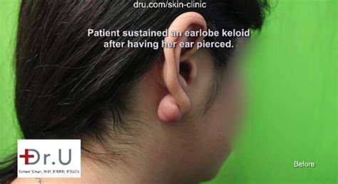 Video Flap Excision Surgery Corrected Earlobe Keloid