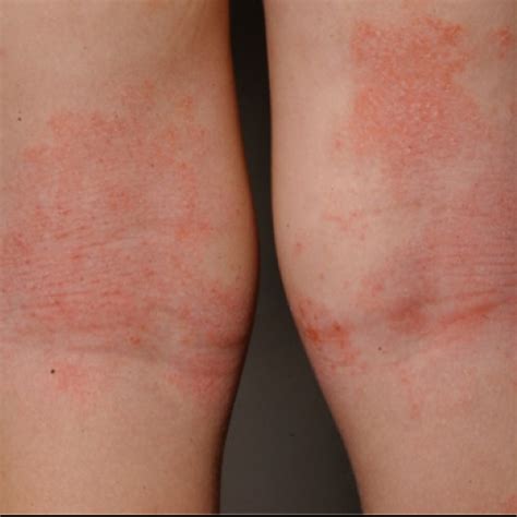 What Does Atopic Dermatitis Look Like